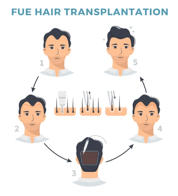 تقنيات زراعة الشعر FUE