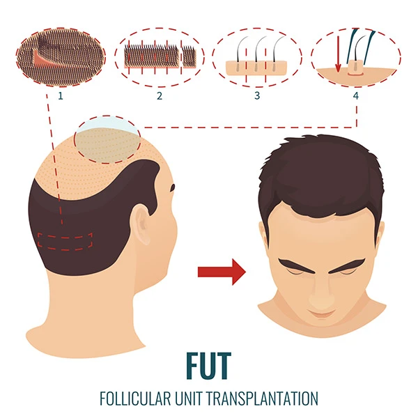 تقنيات زراعة الشعر FUT